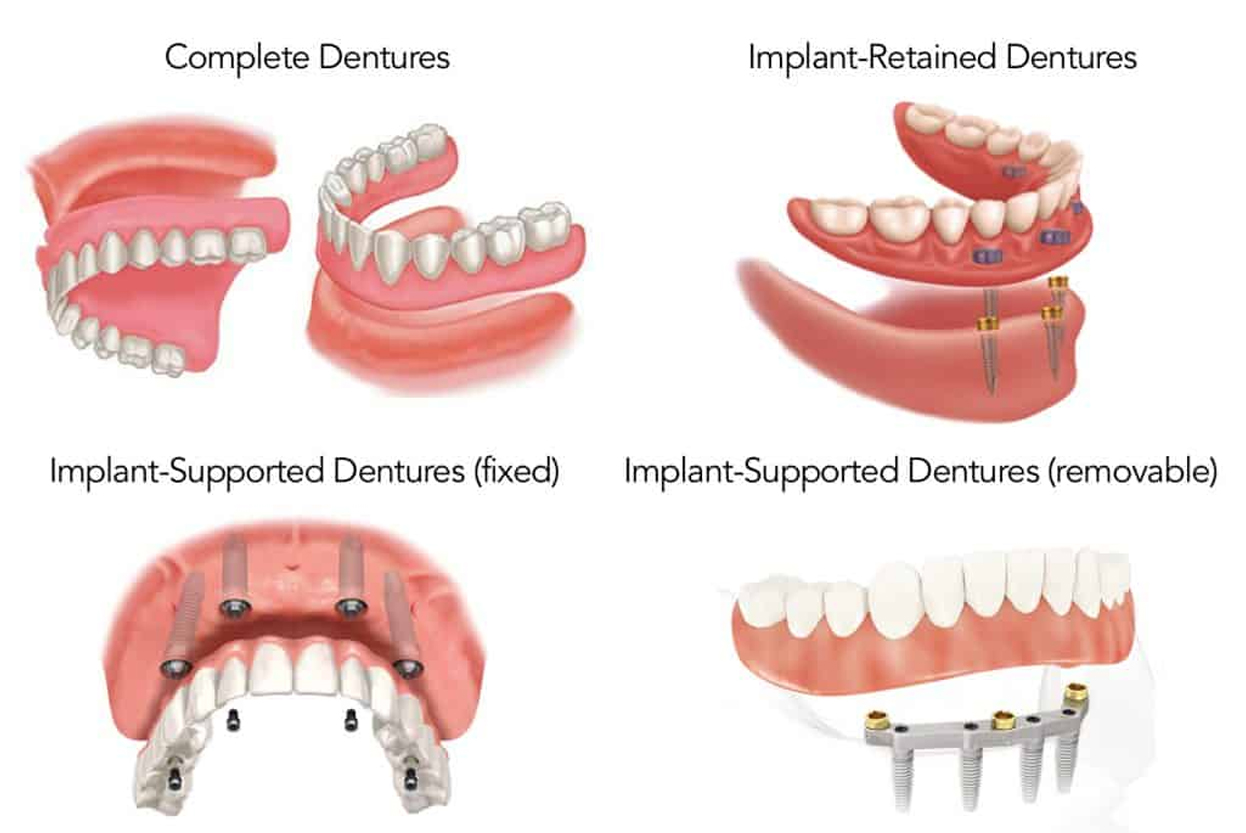 Removable Dentures