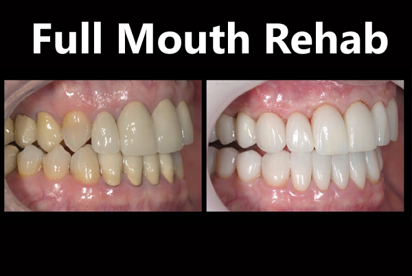 Full Mouth Rehabilitation