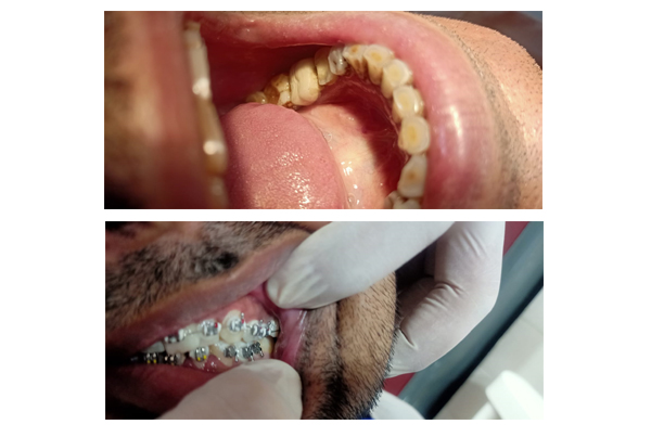 Full Mouth Rehabilitation