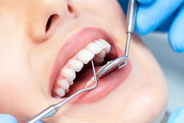 Tooth Extraction