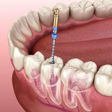 Root Canal Treatment