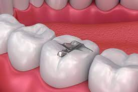 Teeth alignment