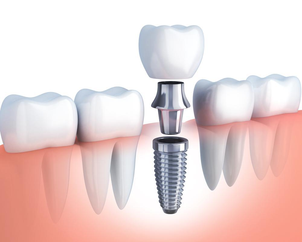 Dental Implant Treatment