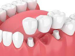 Dental bridge implant