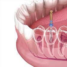 Root Canal Treatment