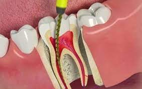 ROOT CANAL TREATMENT