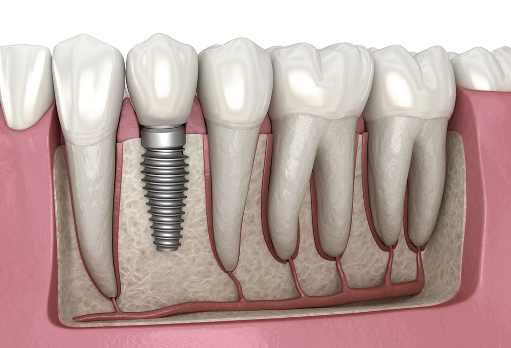 Dental Implant Clinic